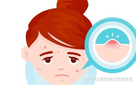 女生 痘痘|痘痘一直不好怎么办？这 3 条建议你绝对需要